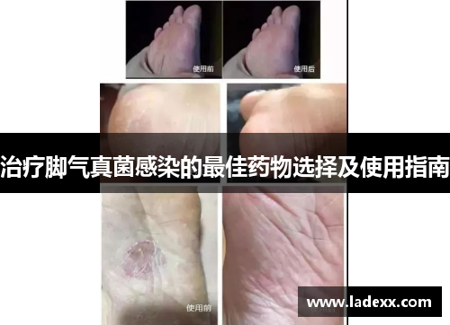 治疗脚气真菌感染的最佳药物选择及使用指南